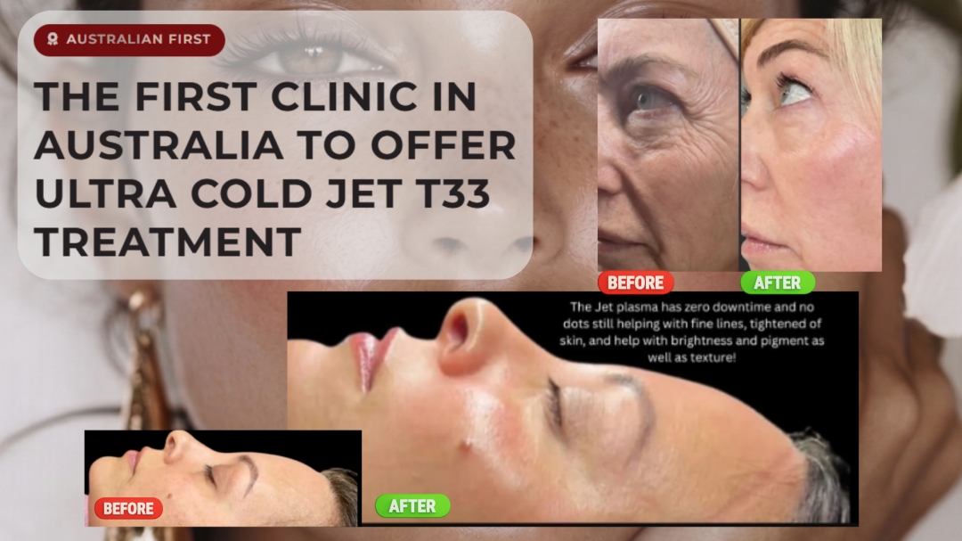 Fibro Plasma Perth becomes first Australian provider of Ultra Cold Jet T33 plasma technology